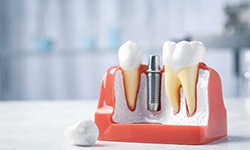 Model of dental implant with crown sitting nearby