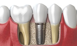 Illustration of dental implant in jawbone