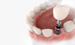 Dental crown being attached to dental implant post in lower arch