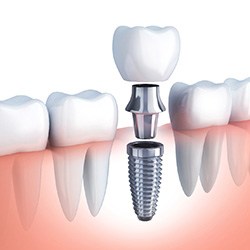 Digital diagram of dental implants in Frisco 