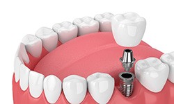Digital illustration of a single tooth dental implant in Frisco
