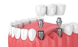Digital illustration of implant bridge replacing multiple missing teeth in Frisco