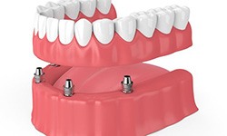 Digital illustration of an implant denture in Frisco