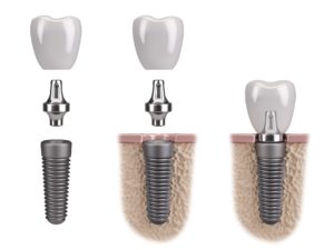 dental implant