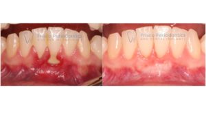 A patient's gums before and after a gum graft.