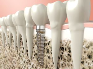 Dental implant in jawbone