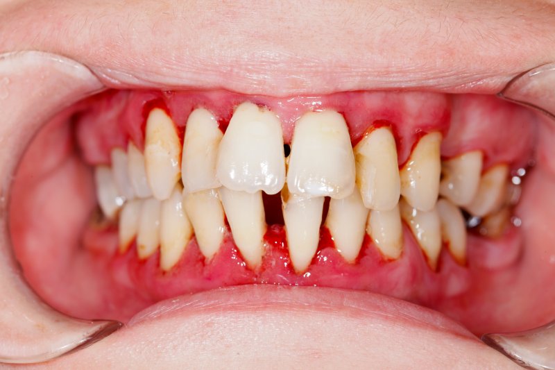 A person with periodontitis.