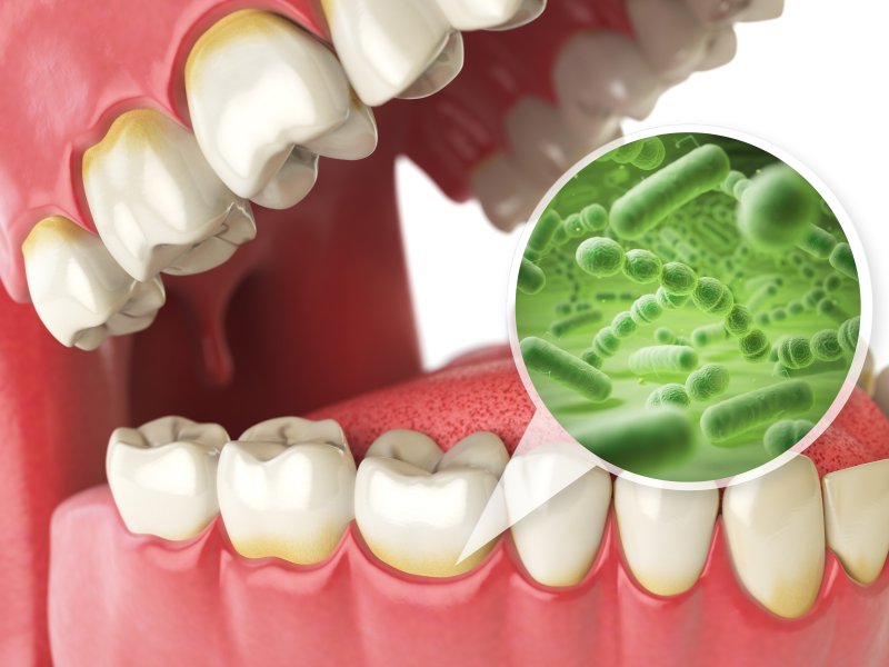 Diagram of a mouth treated with antibiotic therapy in Frisco