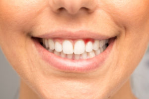 Close up of woman's smile with inflamed gums