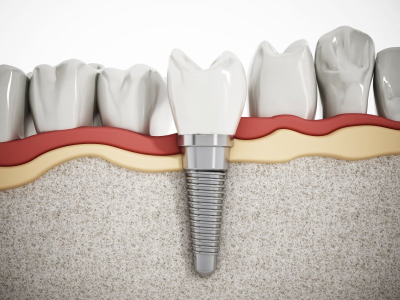 example of a dental implant in Frisco