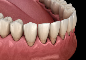 Render of gum recession in the lower arch