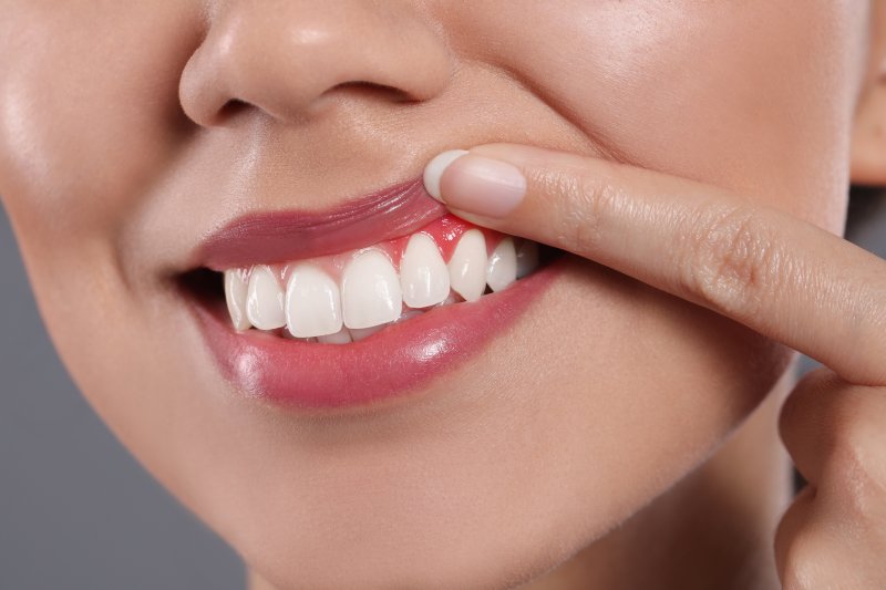 A young woman showing inflamed gums