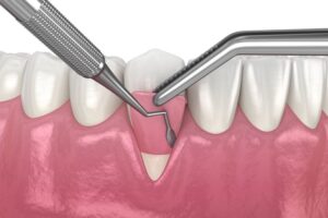 Illustration of gum graft being placed on tooth root