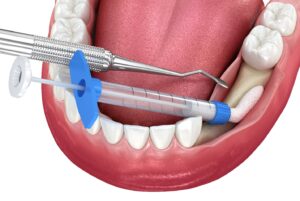Digital rendering of bone grafting.