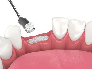 Illustration of bone graft being placed at site of missing teeth